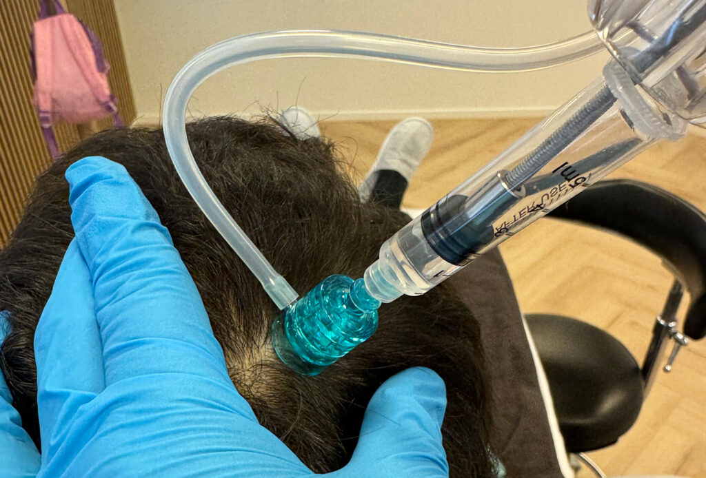 behandeling_meso Mesotherapie