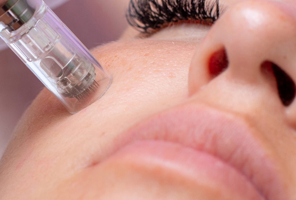 behandeling_micro Microneedling